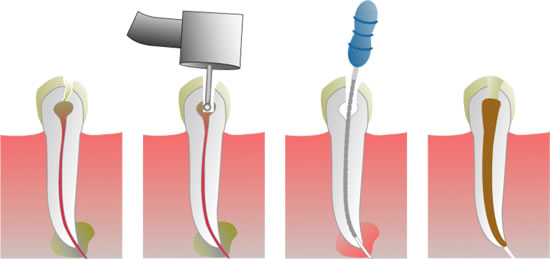 Root canal treatment
